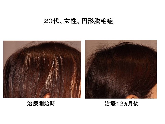 円形脱毛症　病院""